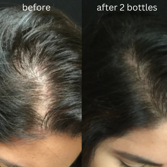 VR Hair Growth Oil for Reducing Hair Fall & Eliminating Dandruff